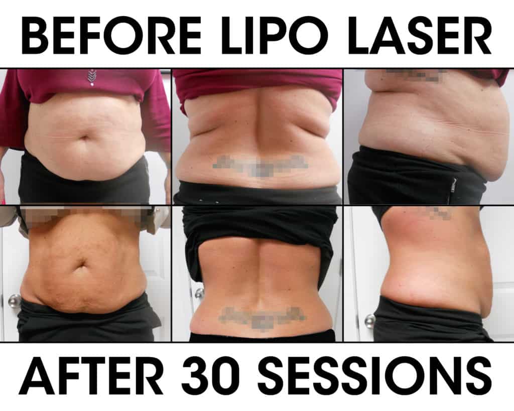 Lipo Laser Weight Loss Liberation Chiropractic & Wellness