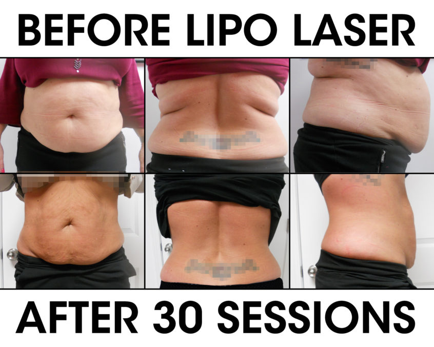 Does Laser Lipo Treatment Work